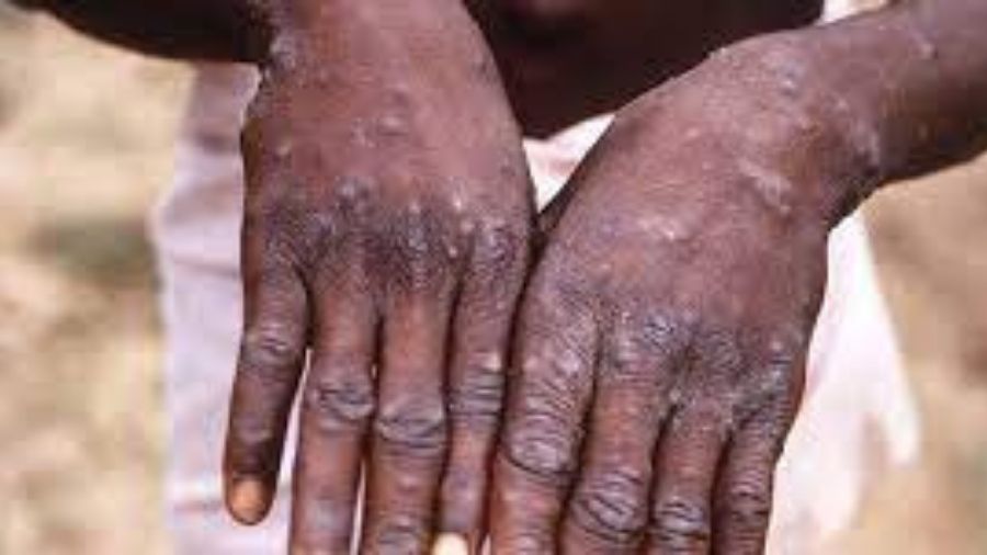 A 35-year-old man, living in Delhi has tested positive for monkeypox