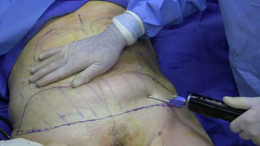 A plastic surgeon performing liposuction surgery
