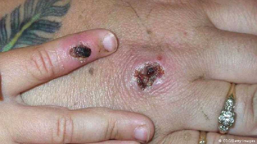Monkeypox is related to but usually less serious than smallpox, although it can be fatal in some cases