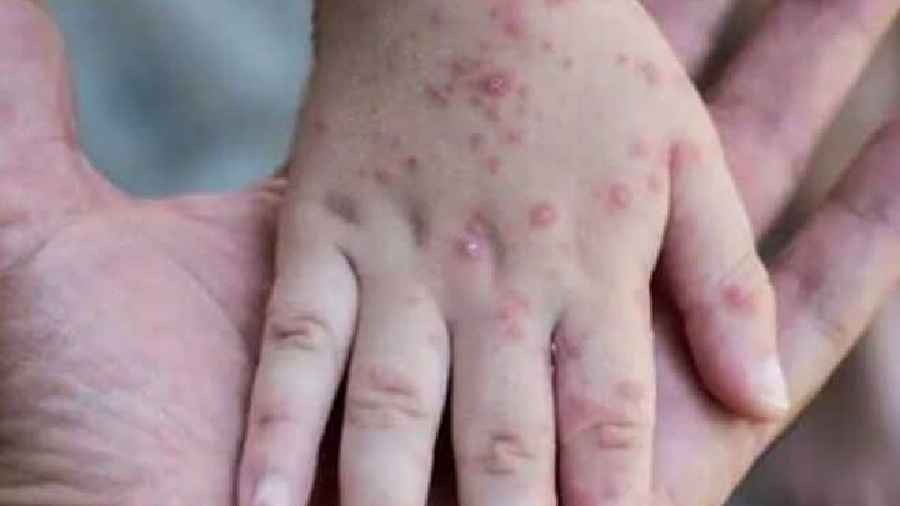 Monkeypox  is a viral infection that commonly presents with fever, headache, muscle pain, rash 