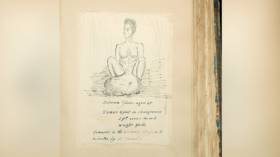 ‘Image of a drawing of a man, named Boleram Ghose, with a 90 lb tumor extending from his abdominal area. Under the drawing it is explained that the tumor had been removed in the mesmeric sleep, in three minutes, by Dr. Esdaile’ 