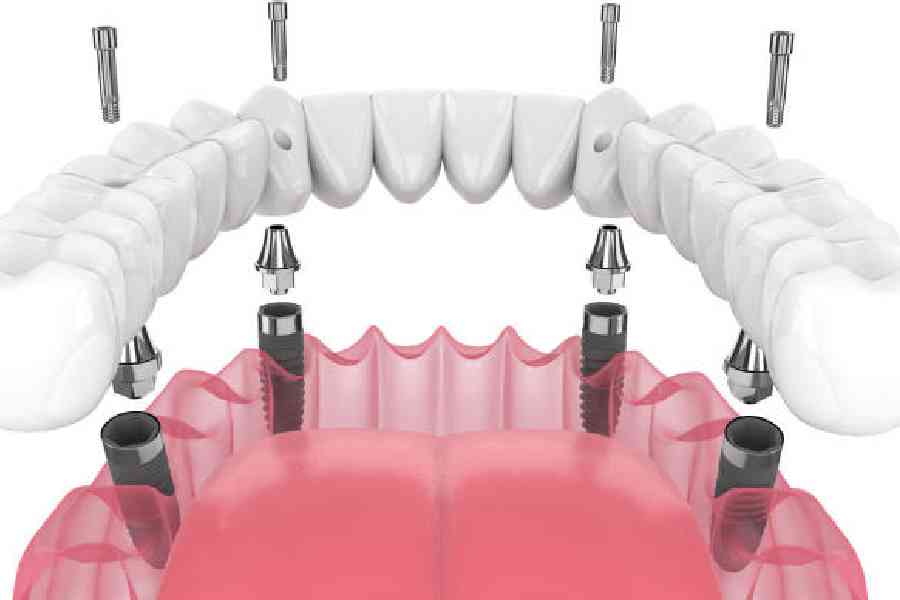 Implant for full set of teeth