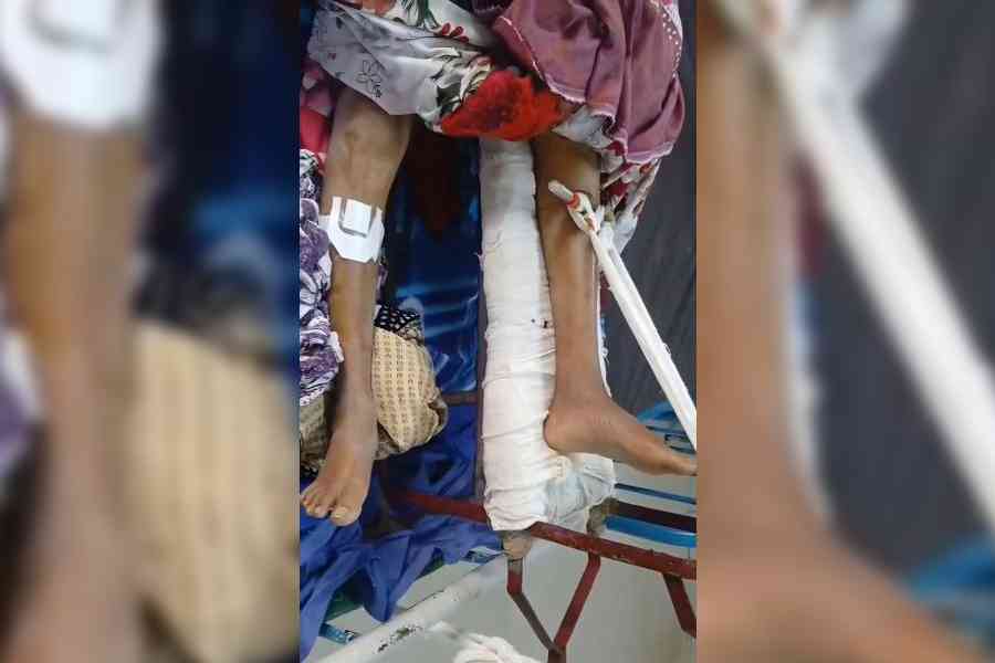 Renu Bewa suffered a fracture in her left hip joint, but the traction was given to her right leg at Murshidabad Medical College and Hospital on Friday. Picture by Abdul Halim