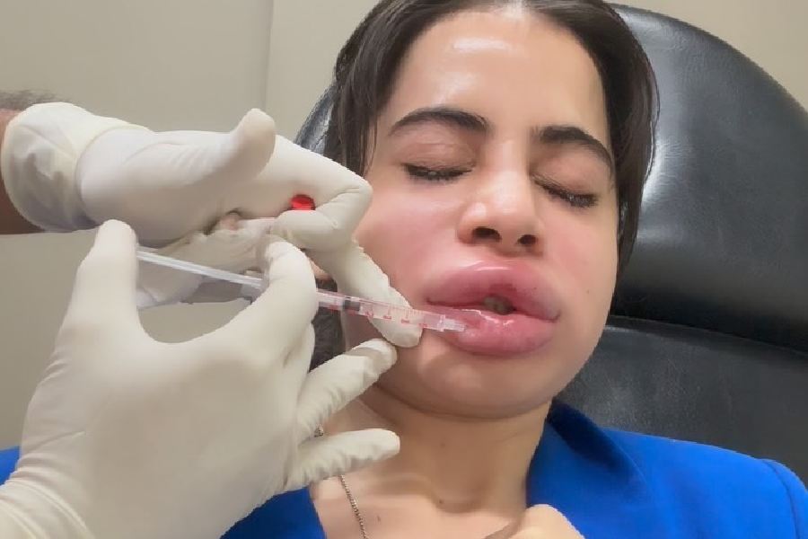 Uorfi Javed undergoing fillers removal procedure