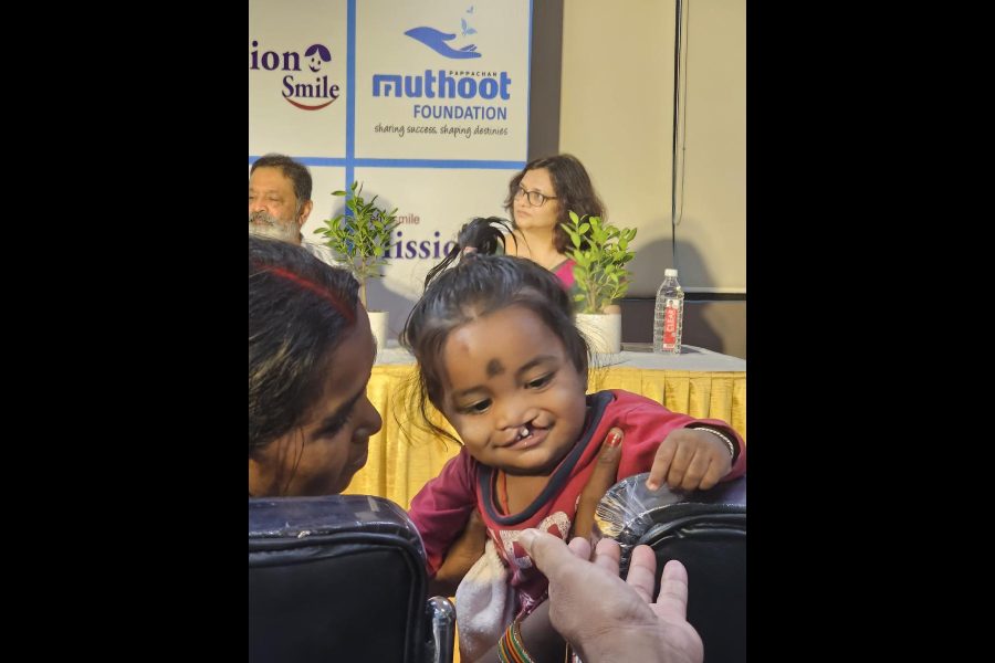 A child with a cleft lip who would be operated on at the camp