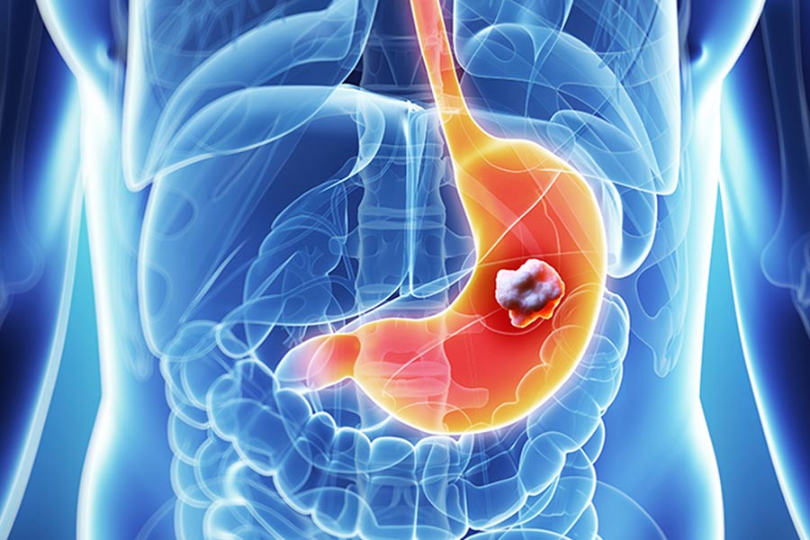 Cancers that develop in any of the organs located within the abdomen are referred to as abdominal or stomach cancers