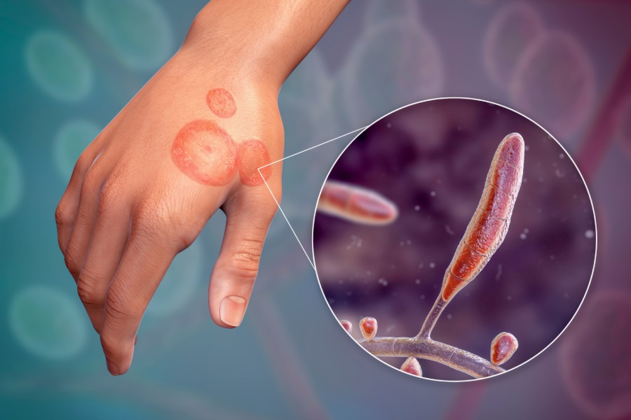 Common fungal infections include athlete’s foot, ringworm, scalp infections, nail infections and jock itch