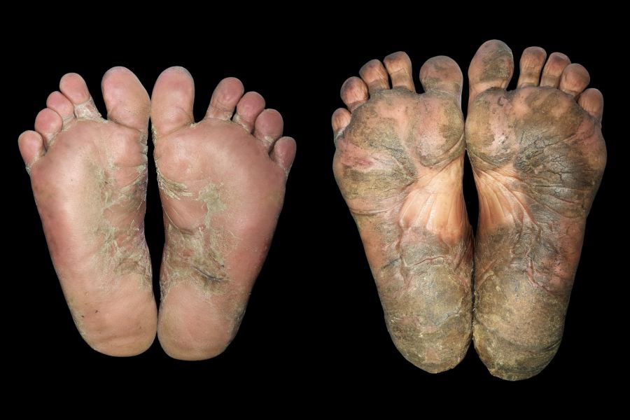 Left: Plantar psoriasis causing silvery scales and fissured feet; Right: Hyperkeratotic eczema leading to thickened skin with cracks