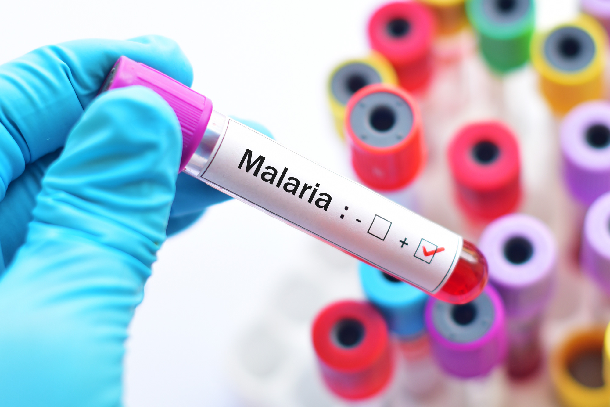 Blood sample with malaria parasite positive