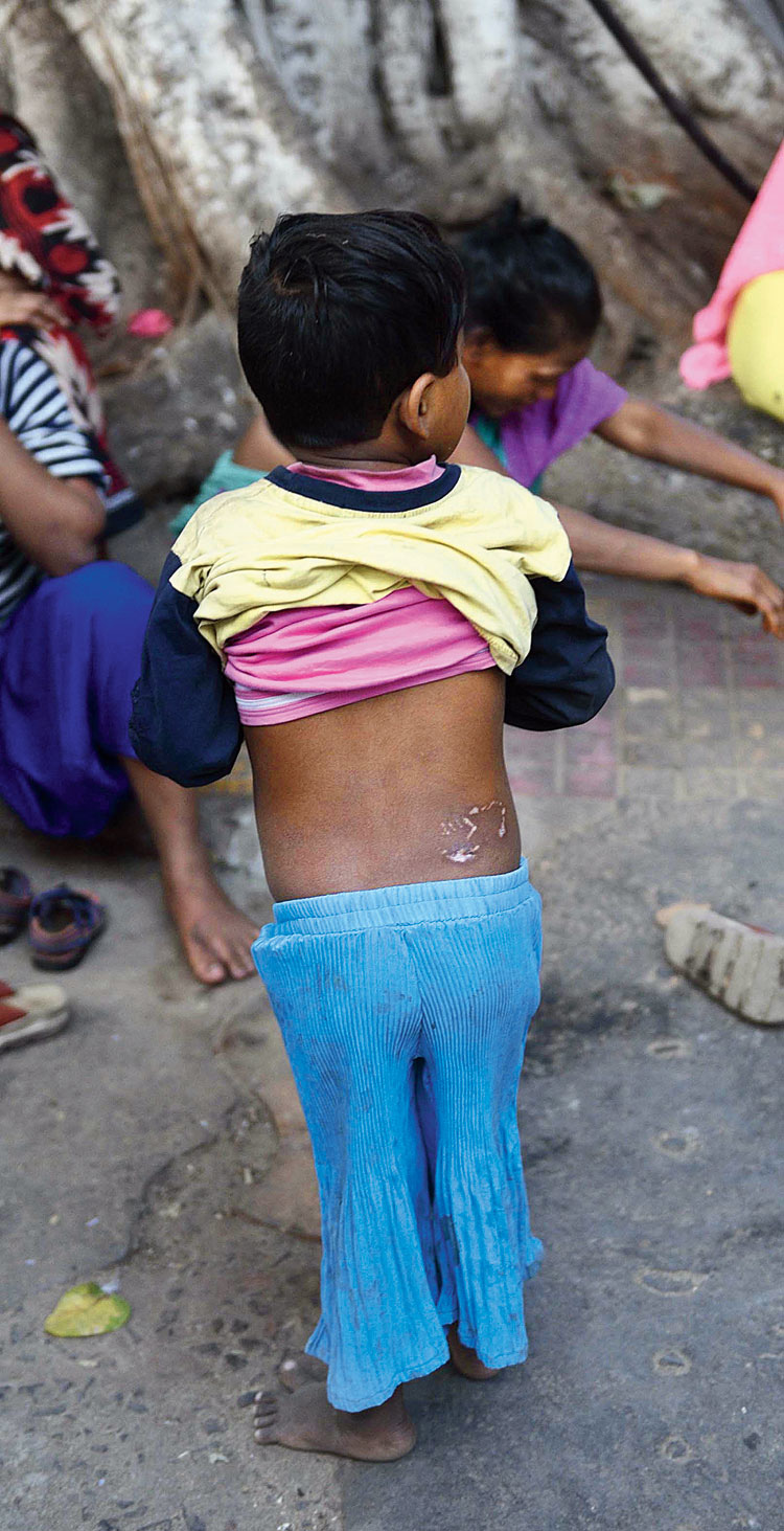 Scars on the back of a four-year-old child who was bitten by a dog on NRS campus