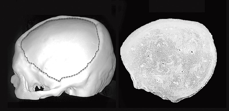 The IISC team printed this 3D model of a defective skull and (right) the acrylic flap that was used to mend it
