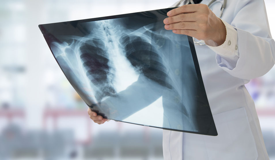 Free chest X-ray vouchers push up TB diagnosis: Study
