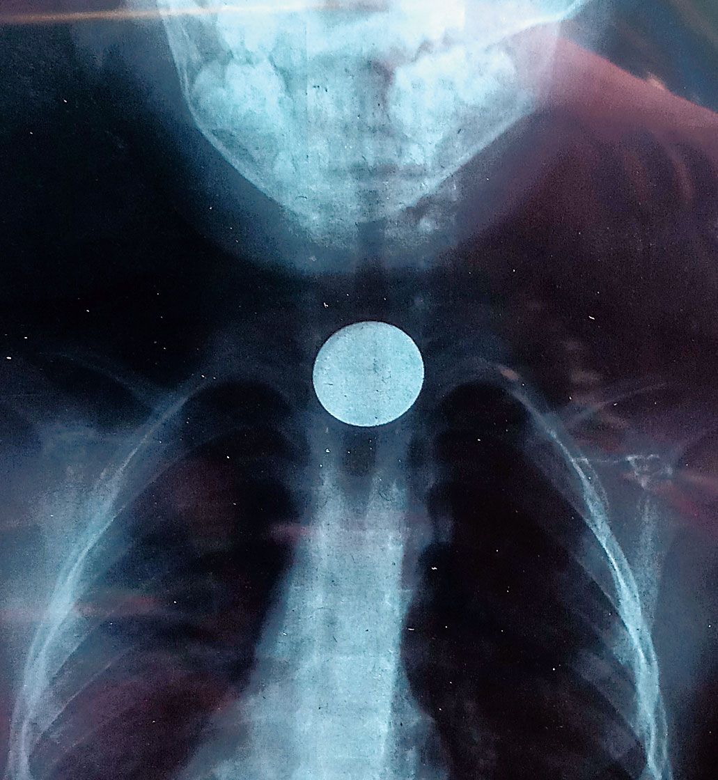 Arghya’s X-ray shows the coin stuck in the throat, where the food pipe and the wind pipe branch out.
